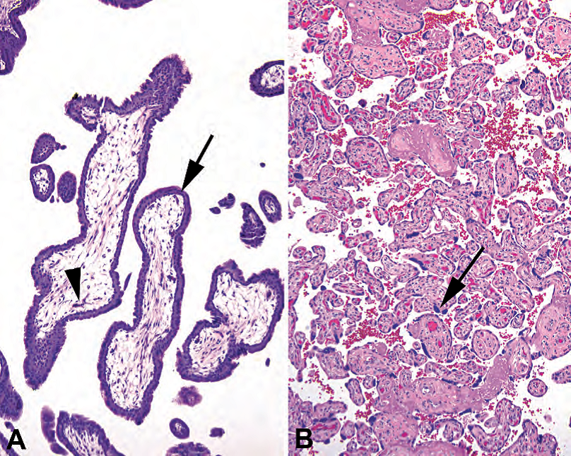 外科病理学实践：诊断过程的初学者指南 | 第18章 胎盘（Placenta）