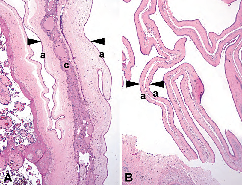 外科病理学实践：诊断过程的初学者指南 | 第18章 胎盘（Placenta）