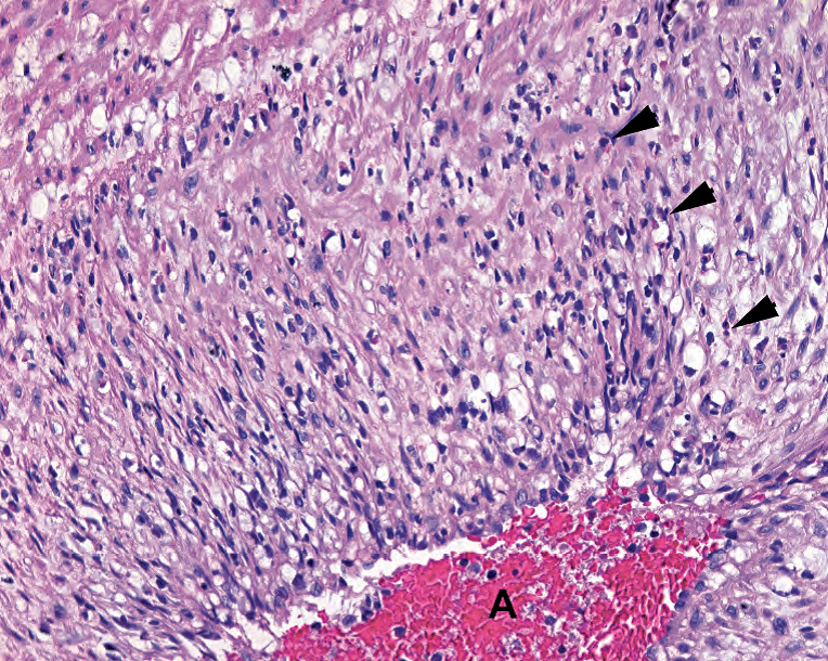 外科病理学实践：诊断过程的初学者指南 | 第18章 胎盘（Placenta）