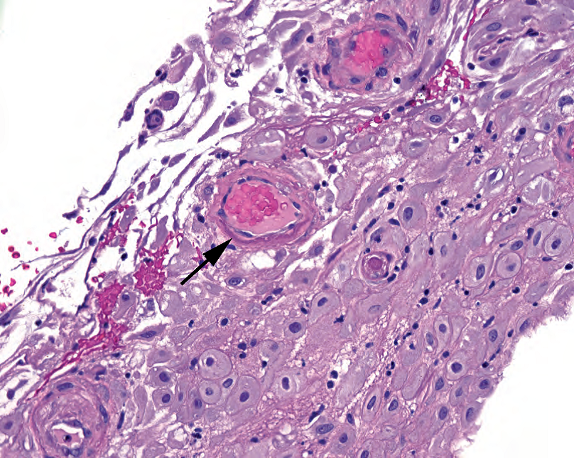 外科病理学实践：诊断过程的初学者指南 | 第18章 胎盘（Placenta）